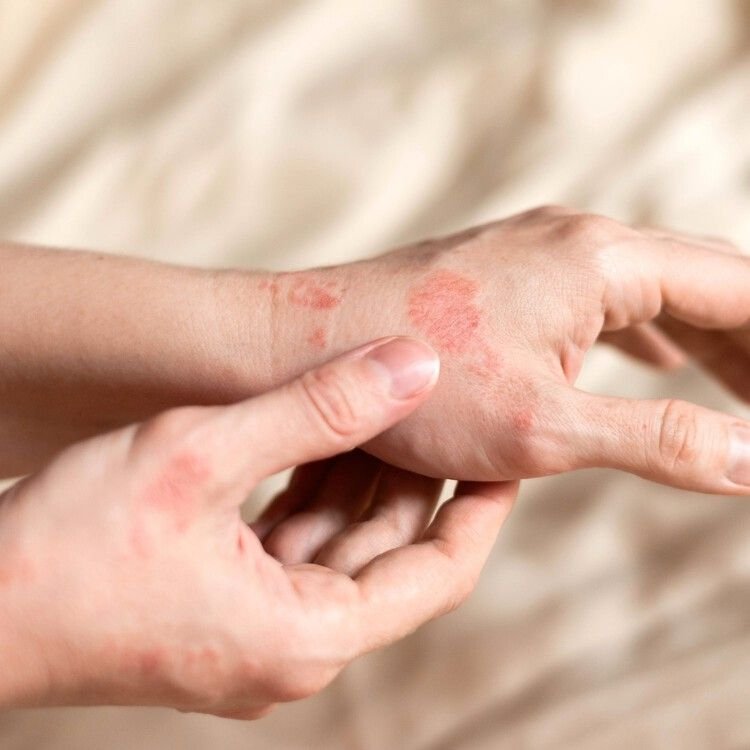 Hemiplegia