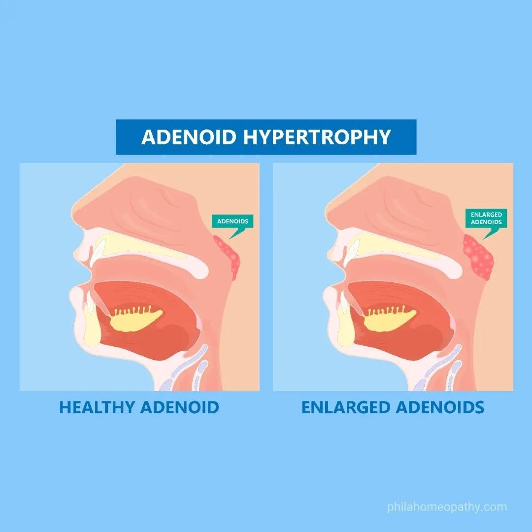 Chronic Adenoiditis
