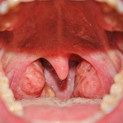 Tonsillitis